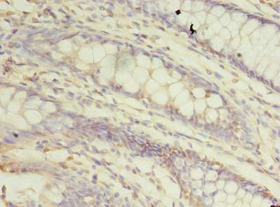 TRAPPC3 Antibody - Immunohistochemistry of paraffin-embedded human colon cancer using TRAPPC3 Antibody at dilution of 1:100