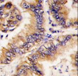 TRAPPC4 / Synbindin Antibody - Formalin-fixed and paraffin-embedded human lung carcinoma tissue reacted with TRAPPC4 antibody , which was peroxidase-conjugated to the secondary antibody, followed by DAB staining. This data demonstrates the use of this antibody for immunohistochemistry; clinical relevance has not been evaluated.
