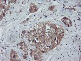 TRAPPC4 / Synbindin Antibody - IHC of paraffin-embedded Adenocarcinoma of Human breast tissue using anti-TRAPPC4 mouse monoclonal antibody.