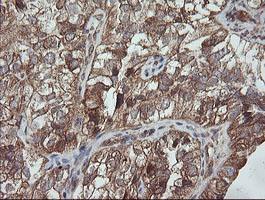 TRAPPC4 / Synbindin Antibody - IHC of paraffin-embedded Adenocarcinoma of Human ovary tissue using anti-TRAPPC4 mouse monoclonal antibody.