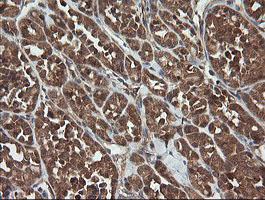 TRAPPC4 / Synbindin Antibody - IHC of paraffin-embedded Carcinoma of Human thyroid tissue using anti-TRAPPC4 mouse monoclonal antibody.