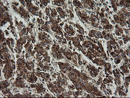 TRAPPC4 / Synbindin Antibody - IHC of paraffin-embedded Carcinoma of Human liver tissue using anti-TRAPPC4 mouse monoclonal antibody.