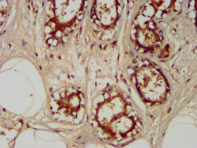 TRAPPC6A Antibody - Immunohistochemistry image at a dilution of 1:400 and staining in paraffin-embedded human breast cancer performed on a Leica BondTM system. After dewaxing and hydration, antigen retrieval was mediated by high pressure in a citrate buffer (pH 6.0) . Section was blocked with 10% normal goat serum 30min at RT. Then primary antibody (1% BSA) was incubated at 4 °C overnight. The primary is detected by a biotinylated secondary antibody and visualized using an HRP conjugated SP system.