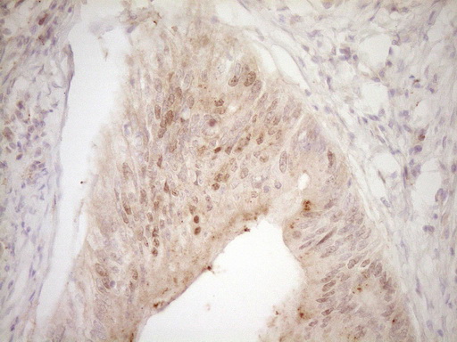 TRB3 / TRIB3 Antibody - Immunohistochemical staining of paraffin-embedded Adenocarcinoma of Human colon tissue using anti-TRIB3 mouse monoclonal antibody. (Heat-induced epitope retrieval by 1 mM EDTA in 10mM Tris, pH8.5, 120C for 3min,