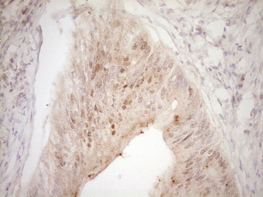 TRB3 / TRIB3 Antibody - IHC of paraffin-embedded Adenocarcinoma of Human colon tissue using anti-TRIB3 mouse monoclonal antibody. (Heat-induced epitope retrieval by 1 mM EDTA in 10mM Tris, pH8.5, 120°C for 3min).