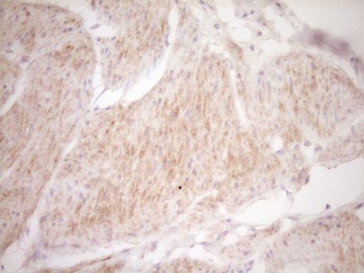 TRB3 / TRIB3 Antibody - Immunohistochemical staining of paraffin-embedded Carcinoma of Human bladder tissue using anti-TRIB3 mouse monoclonal antibody. (Heat-induced epitope retrieval by 1 mM EDTA in 10mM Tris, pH8.5, 120C for 3min,