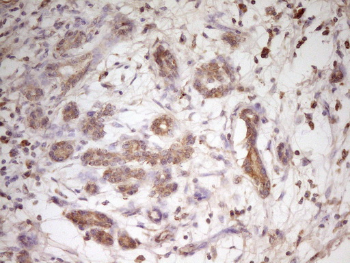 TRB3 / TRIB3 Antibody - IHC of paraffin-embedded Carcinoma of Human pancreas tissue using anti-TRIB3 mouse monoclonal antibody. (Heat-induced epitope retrieval by 1 mM EDTA in 10mM Tris, pH8.5, 120°C for 3min).