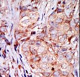 TRB3 / TRIB3 Antibody - Formalin-fixed and paraffin-embedded human cancer tissue reacted with the primary antibody, which was peroxidase-conjugated to the secondary antibody, followed by AEC staining. This data demonstrates the use of this antibody for immunohistochemistry; clinical relevance has not been evaluated. BC = breast carcinoma; HC = hepatocarcinoma.