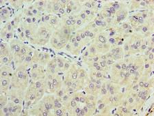 TRBC1 Antibody - Immunohistochemistry of paraffin-embedded human liver cancer using TRBC1 Antibody at dilution of 1:100