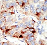 TRDMT1 / DNMT2 Antibody - Formalin-fixed and paraffin-embedded human cancer tissue reacted with the primary antibody, which was peroxidase-conjugated to the secondary antibody, followed by DAB staining. This data demonstrates the use of this antibody for immunohistochemistry; clinical relevance has not been evaluated. BC = breast carcinoma; HC = hepatocarcinoma.