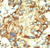 TRDMT1 / DNMT2 Antibody - Formalin-fixed and paraffin-embedded human cancer tissue reacted with the primary antibody, which was peroxidase-conjugated to the secondary antibody, followed by DAB staining. This data demonstrates the use of this antibody for immunohistochemistry; clinical relevance has not been evaluated. BC = breast carcinoma; HC = hepatocarcinoma.