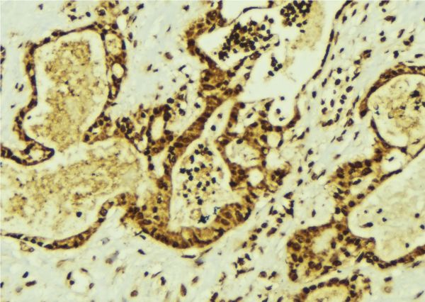Treacle / TCOF1 Antibody - 1:100 staining human breast carcinoma tissue by IHC-P. The sample was formaldehyde fixed and a heat mediated antigen retrieval step in citrate buffer was performed. The sample was then blocked and incubated with the antibody for 1.5 hours at 22°C. An HRP conjugated goat anti-rabbit antibody was used as the secondary.