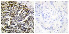 Treacle / TCOF1 Antibody - Peptide - + Immunohistochemistry analysis of paraffin-embedded human lung carcinoma tissue using TCOF1 antibody.