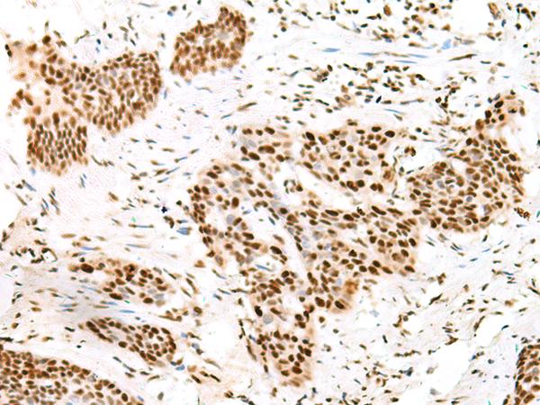 Treacle / TCOF1 Antibody - Immunohistochemistry of paraffin-embedded Human esophagus cancer tissue  using TCOF1 Polyclonal Antibody at dilution of 1:50(×200)
