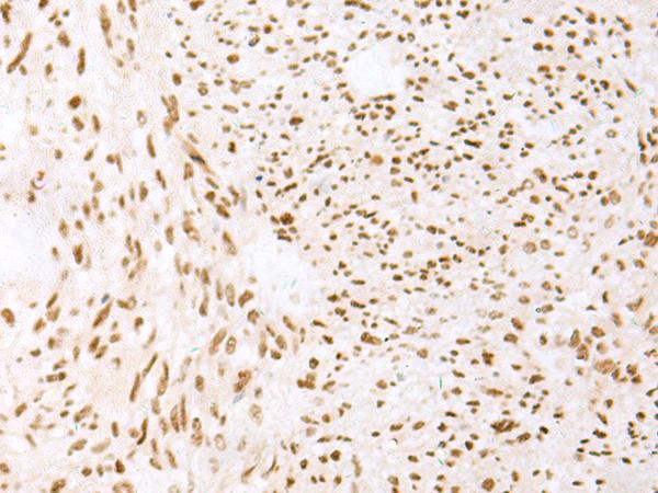 Treacle / TCOF1 Antibody - Immunohistochemistry of paraffin-embedded Human liver cancer tissue  using TCOF1 Polyclonal Antibody at dilution of 1:50(×200)
