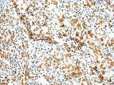 Treacle / TCOF1 Antibody - Immunohistochemistry of paraffin-embedded Human cervical cancer tissue  using TCOF1 Polyclonal Antibody at dilution of 1:50(×200)