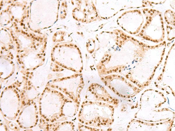 Treacle / TCOF1 Antibody - Immunohistochemistry of paraffin-embedded Human thyroid cancer tissue  using TCOF1 Polyclonal Antibody at dilution of 1:50(×200)