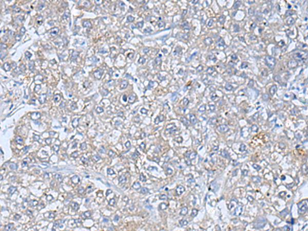 TREM1 Antibody - Immunohistochemistry of paraffin-embedded Human liver cancer tissue  using TREM1 Polyclonal Antibody at dilution of 1:50(×200)