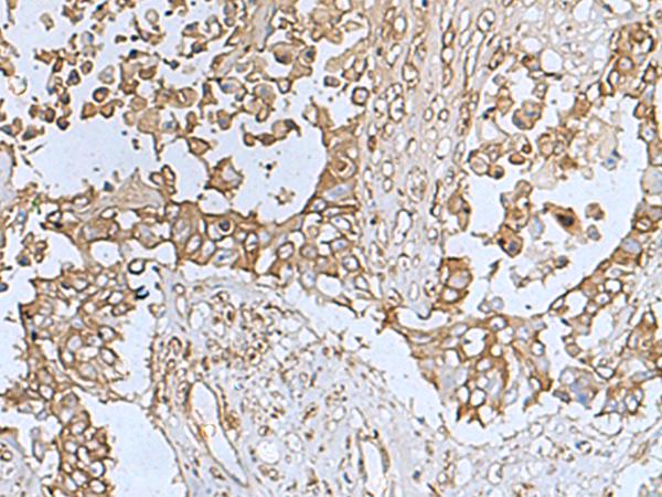 TREM1 Antibody - Immunohistochemistry of paraffin-embedded Human colorectal cancer tissue  using TREM1 Polyclonal Antibody at dilution of 1:50(×200)