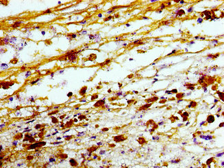TREM2 / TREM-2 Antibody - Immunohistochemistry image of paraffin-embedded human melanoma cancer at a dilution of 1:100