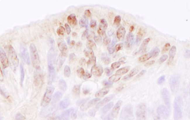 TRERF1 Antibody - Detection of Human TReP-132/TRERF1 by Immunohistochemistry. Sample: FFPE section of human ovarian carcinoma. Antibody: Affinity purified rabbit anti-TReP-132/TRERF1 used at a dilution of 1:5000 (0.2 ug/ml). Detection: DAB.