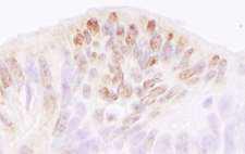 TRERF1 Antibody - Detection of Human TReP-132/TRERF1 by Immunohistochemistry. Sample: FFPE section of human ovarian carcinoma. Antibody: Affinity purified rabbit anti-TReP-132/TRERF1 used at a dilution of 1:5000 (0.2 ug/ml). Detection: DAB.