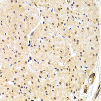 TRF1 / TERF1 Antibody - Immunohistochemistry of paraffin-embedded human gastric cancer using TERF1 antibodyat dilution of 1:200 (40x lens).