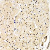 TRF1 / TERF1 Antibody - Immunohistochemistry of paraffin-embedded human gastric cancer using TERF1 antibodyat dilution of 1:200 (40x lens).