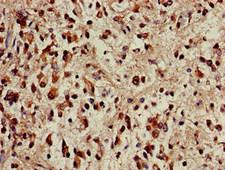 TRF1 / TERF1 Antibody - Immunohistochemistry of paraffin-embedded human glioma cancer at dilution of 1:100