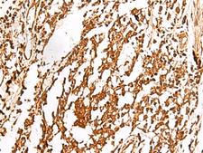 TRF1 / TERF1 Antibody - Immunohistochemistry of paraffin-embedded Human lung cancer tissue  using TERF1 Polyclonal Antibody at dilution of 1:30(×200)