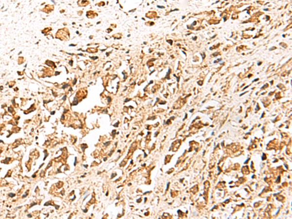 TRF1 / TERF1 Antibody - Immunohistochemistry of paraffin-embedded Human prost ate cancer tissue  using TERF1 Polyclonal Antibody at dilution of 1:30(×200)
