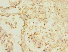TRHDE Antibody - Immunohistochemistry of paraffin-embedded human breast cancer at dilution 1:100