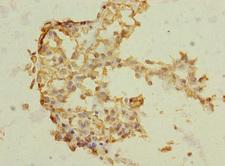 TRHDE Antibody - Immunohistochemistry of paraffin-embedded human breast cancer at dilution 1:100