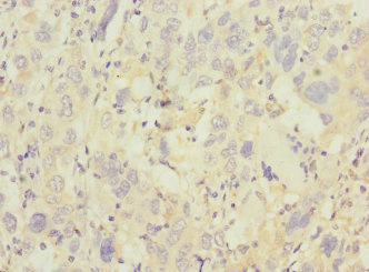 TRHDE Antibody - Immunohistochemistry of paraffin-embedded human liver cancer at dilution 1:100
