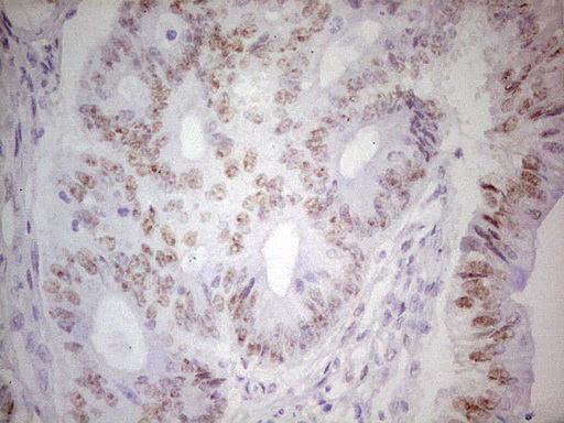 TRIB1 Antibody - Immunohistochemical staining of paraffin-embedded Adenocarcinoma of Human colon tissue using anti-TRIB1 mouse monoclonal antibody. (Heat-induced epitope retrieval by 1 mM EDTA in 10mM Tris, pH8.5, 120C for 3min,