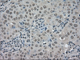 TRIB2 Antibody - IHC of paraffin-embedded Adenocarcinoma of breast tissue using anti-TRIB2 mouse monoclonal antibody. (Dilution 1:50).