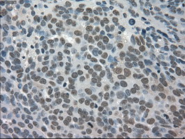 TRIB2 Antibody - IHC of paraffin-embedded Adenocarcinoma of ovary tissue using anti-TRIB2 mouse monoclonal antibody. (Dilution 1:50).