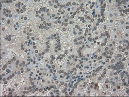 TRIB2 Antibody - IHC of paraffin-embedded Carcinoma of kidney tissue using anti-TRIB2 mouse monoclonal antibody. (Dilution 1:50).
