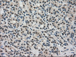 TRIB2 Antibody - IHC of paraffin-embedded Carcinoma of thyroid tissue using anti-TRIB2 mouse monoclonal antibody. (Dilution 1:50).