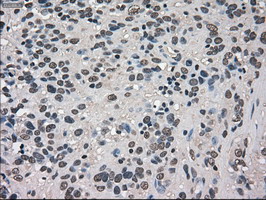 TRIB2 Antibody - IHC of paraffin-embedded Carcinoma of bladder tissue using anti-TRIB2 mouse monoclonal antibody. (Dilution 1:50).