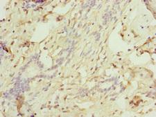 TRIM10 Antibody - Immunohistochemistry of paraffin-embedded human breast cancer at dilution of 1:100