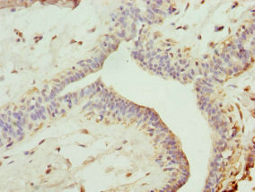 TRIM13 Antibody - Immunohistochemistry of paraffin-embedded human breast cancer at dilution 1:100