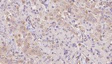 TRIM14 Antibody - 1:100 staining human thyroid carcinoma tissue by IHC-P. The sample was formaldehyde fixed and a heat mediated antigen retrieval step in citrate buffer was performed. The sample was then blocked and incubated with the antibody for 1.5 hours at 22°C. An HRP conjugated goat anti-rabbit antibody was used as the secondary.