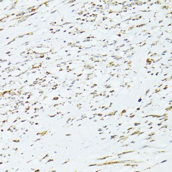 TRIM15 Antibody - Immunohistochemistry of paraffin-embedded human uterine cancer using TRIM15 antibody at dilution of 1:100 (40x lens).