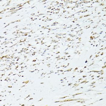 TRIM15 Antibody - Immunohistochemistry of paraffin-embedded Human uterine cancer using TRIM15 Polyclonal Antibody at dilution of 1:100 (40x lens).