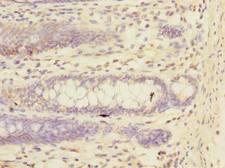 TRIM17 / RNF16 Antibody - Immunohistochemistry of paraffin-embedded human colon cancer using antibody at dilution of 1:100.