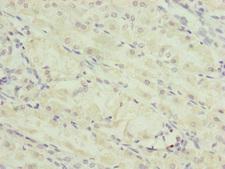 TRIM23 Antibody - Immunohistochemistry of paraffin-embedded human gastric cancer at dilution of 1:100