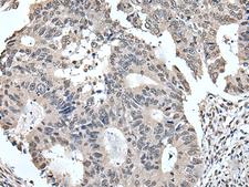 TRIM23 Antibody - Immunohistochemistry of paraffin-embedded Human colorectal cancer tissue  using TRIM23 Polyclonal Antibody at dilution of 1:55(×200)