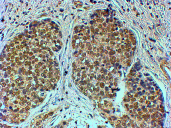 TRIM24 / TIF1 Antibody - Goat Anti-TIF1A / TRIM24 Antibody (4µg/ml) staining of paraffin embedded Human Breast cancer. Steamed antigen retrieval with citrate buffer pH 6, HRP-staining.