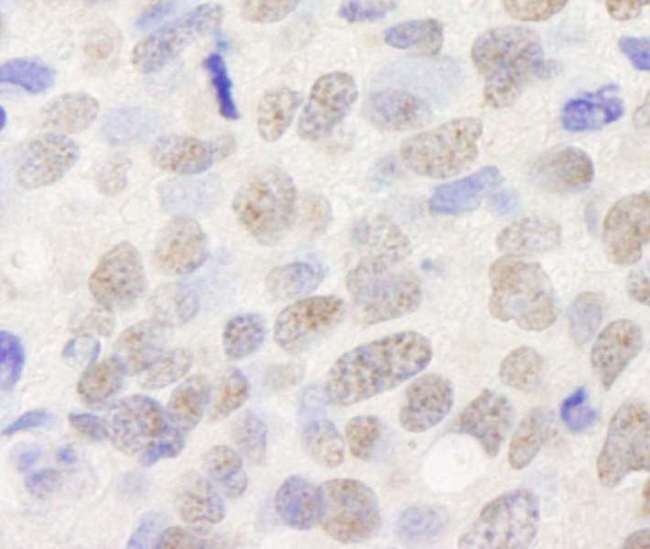 TRIM24 / TIF1 Antibody - Detection of Human TIF1 Alpha / TRIM24 by Immunohistochemistry. Sample: FFPE section of human breast tumor. Antibody: Affinity purified rabbit anti-TIF1 Alpha/TRIM24 used at a dilution of 1:250.
